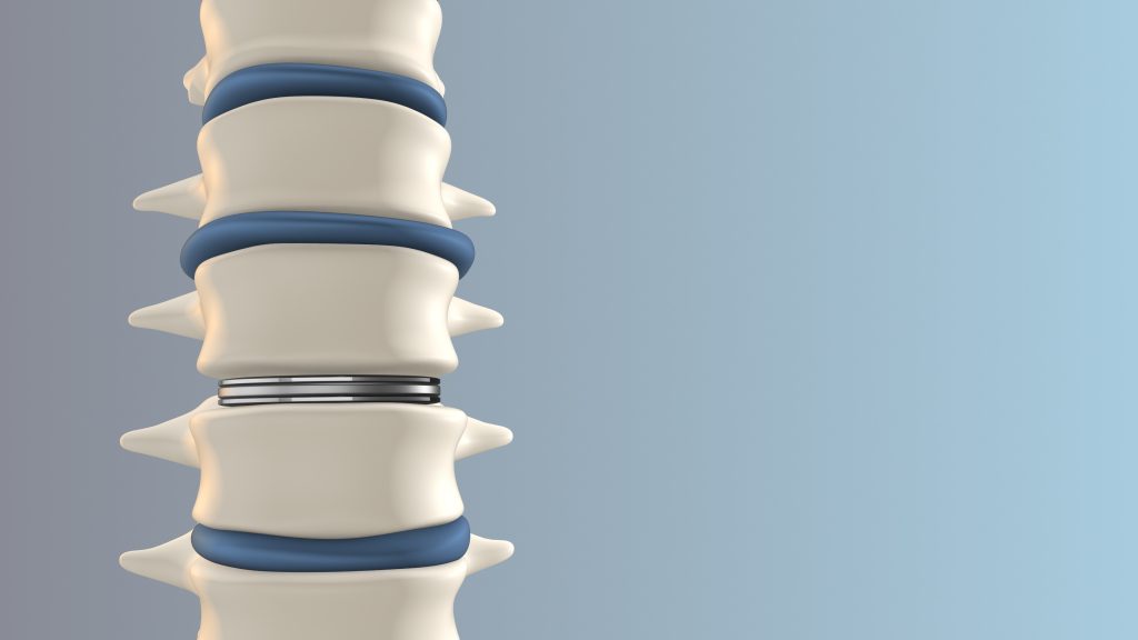 Spinal Disc Replacement